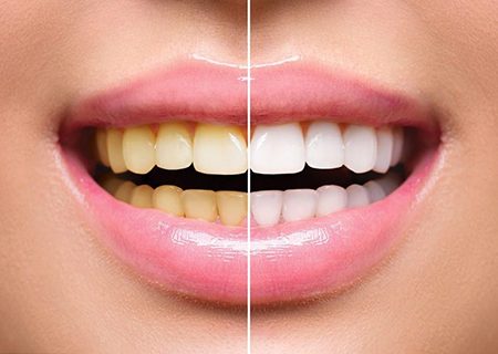 ۱۰ روش طلایی برای سفید کردن دندان‌ها