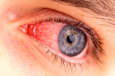«یوئیت» بیماری خطرناک چشمی