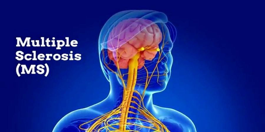 در این سن بیشتر احتمال ابتلا به ام اس وجود دارد